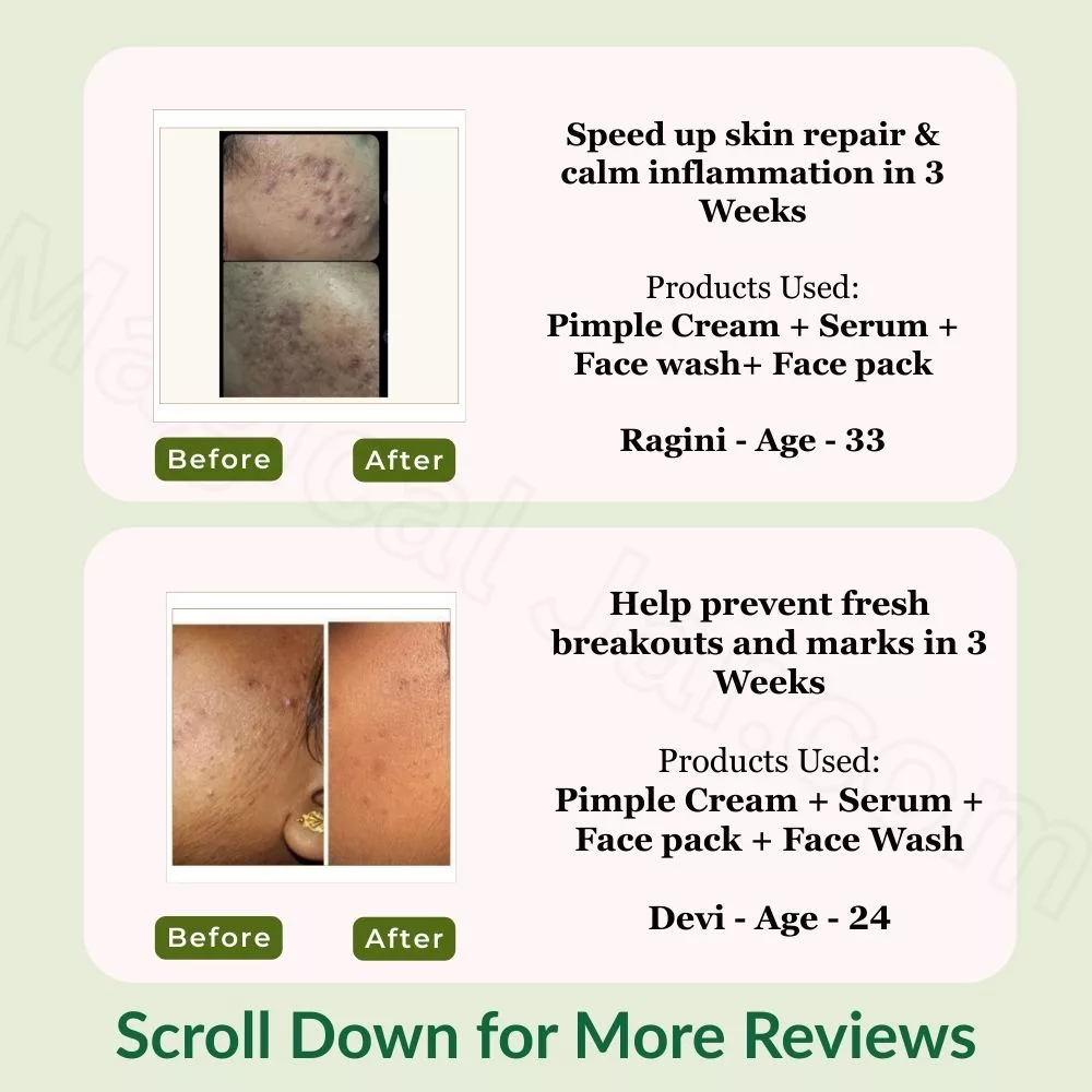 Pimple Care Mini Kit | Pack of 4