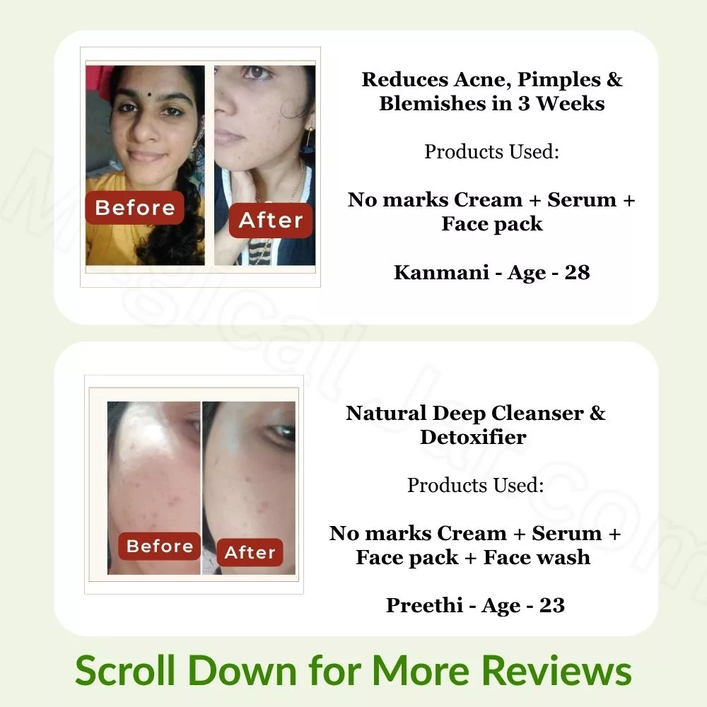 Pimple & Acne Control Face Mask