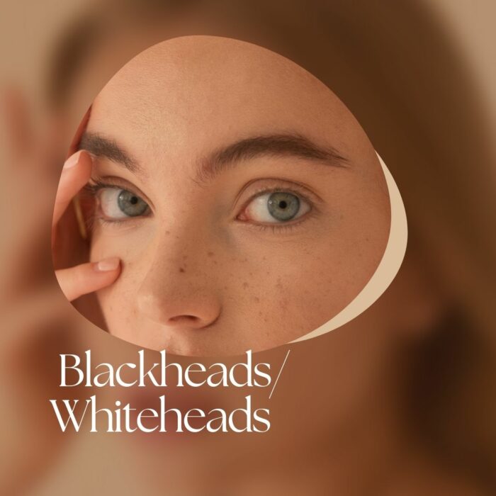 Pores ( Black heads | white heads )
