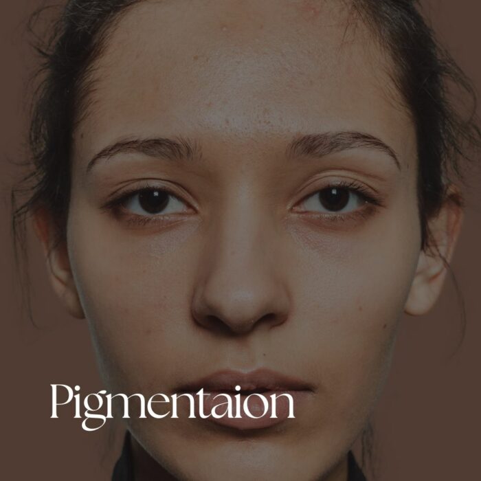 Pigmentation | Hyper pigmentation